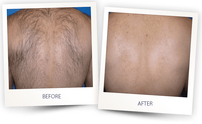 laser-hair-removal-breast