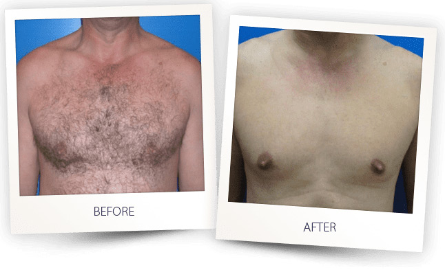 laser-hair-removal-chest